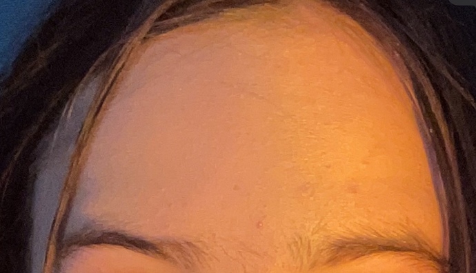 Would u date somebody with this much acne?