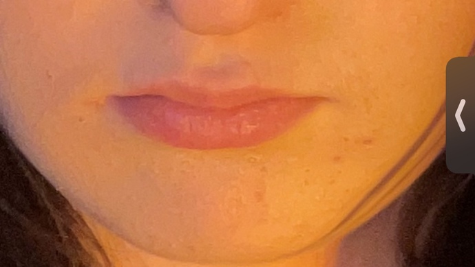 Would u date somebody with this much acne?