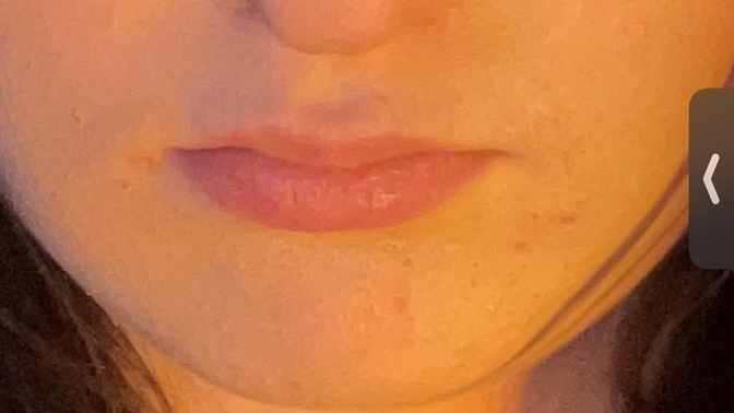 Would u date somebody with this much acne?