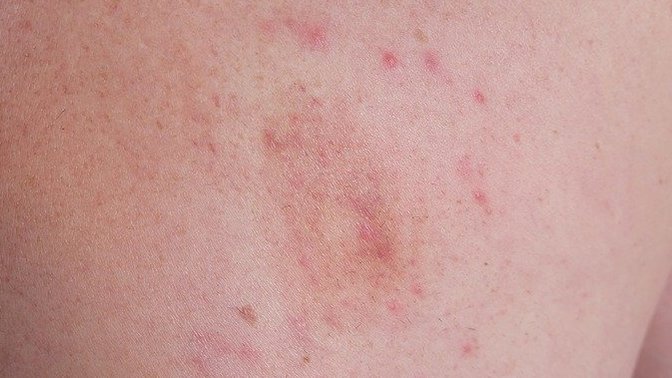 Is this a hickey?
