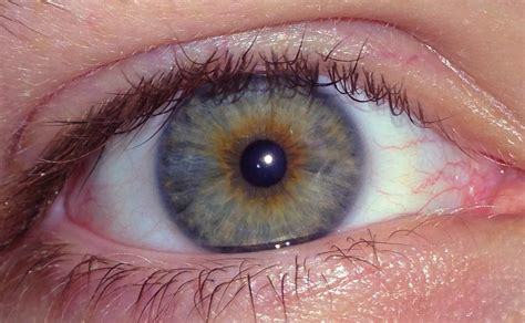 hazel eye