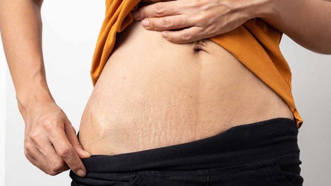 Are stretchmarks on a man unattractive?