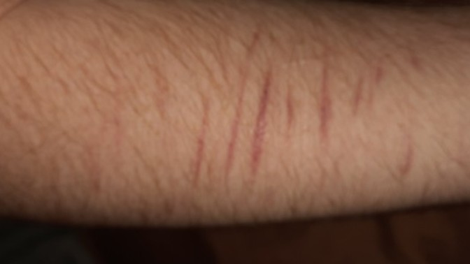 How to hide scars?