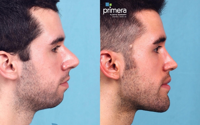 Should more men get plastic surgeries if they are unhappy with their looks?
