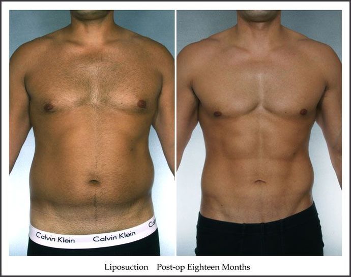 Should more men get plastic surgeries if they are unhappy with their looks?