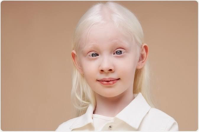 Why do Scandinavians have albinism?