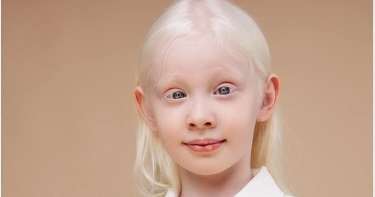 Why do Scandinavians have albinism? GirlsAskGuys