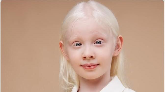Why do Scandinavians have albinism?