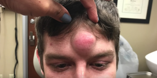 Would you rather have lots of small & painful monkeypox hidden under clothing or a singular, huge & painless monkeypock on your forehead?
