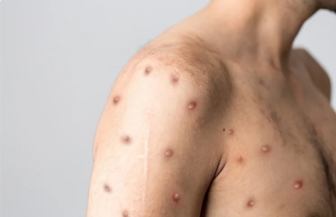 Would you rather have lots of small & painful monkeypox hidden under clothing or a singular, huge & painless monkeypock on your forehead?