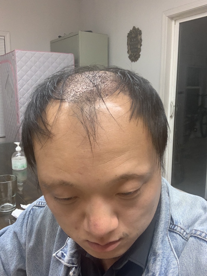 I just had my hair transplant five days ago. What do you think of the scabs?