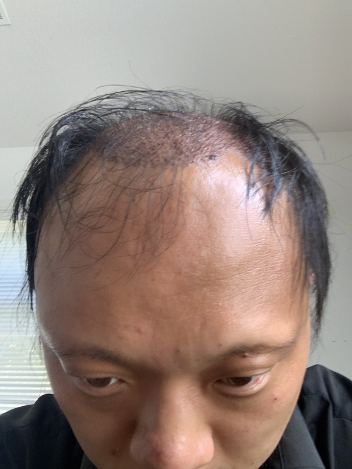 I just had my hair transplant five days ago. What do you think of the scabs?