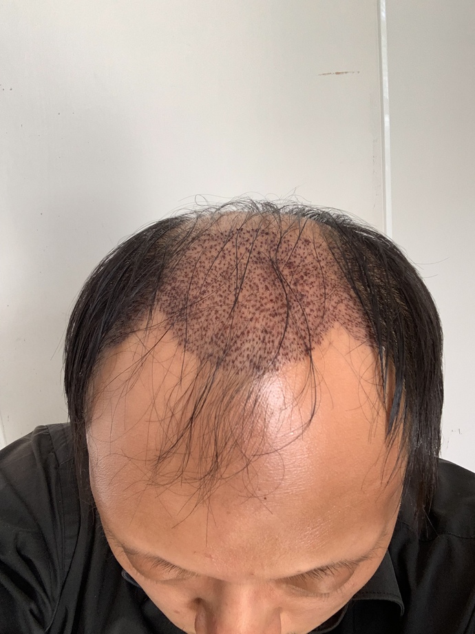 I just had my hair transplant five days ago. What do you think of the scabs?