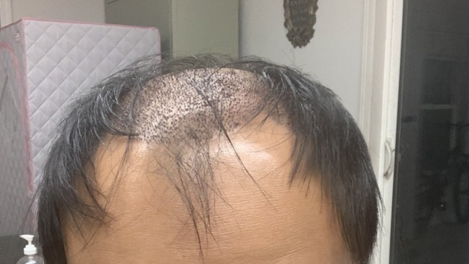 I just had my hair transplant five days ago. What do you think of the scabs?