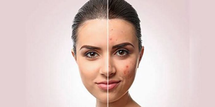 Like this but only on the cheeks and my skin is much whiter