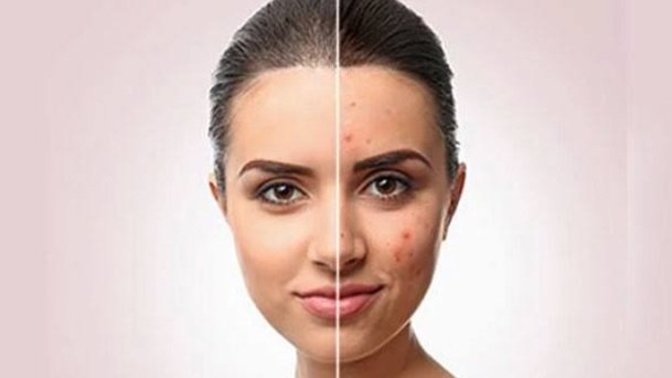 A few pimples affect beauty? Do you get cold from someone like that?