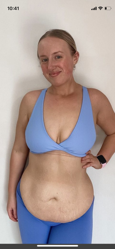 I lost a lot of weight but can’t get rid of the pooch should I get a tummy tuck?