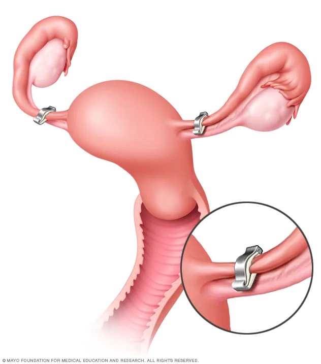 Should women who get irresponsible abortions be required to tie their tubes or pay an abortion fee?