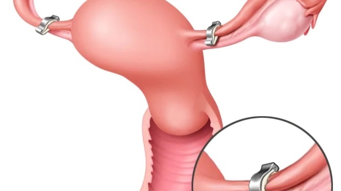 Should women who get irresponsible abortions be required to tie their tubes or pay an abortion fee?