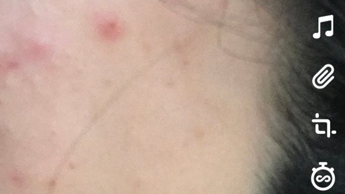 Pimples on my forehead do not go away, what should I do?