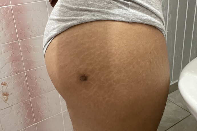 Is the only effective way to get rid of stretch marks is by laser?