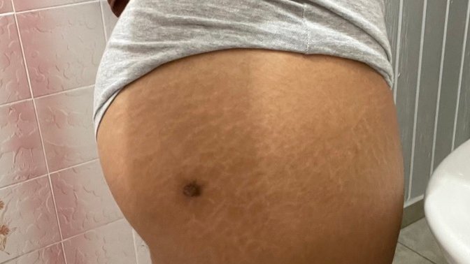 Is the only effective way to get rid of stretch marks is by laser?
