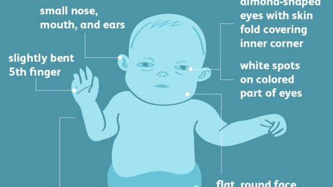 Why do all Down syndrome people look the same?