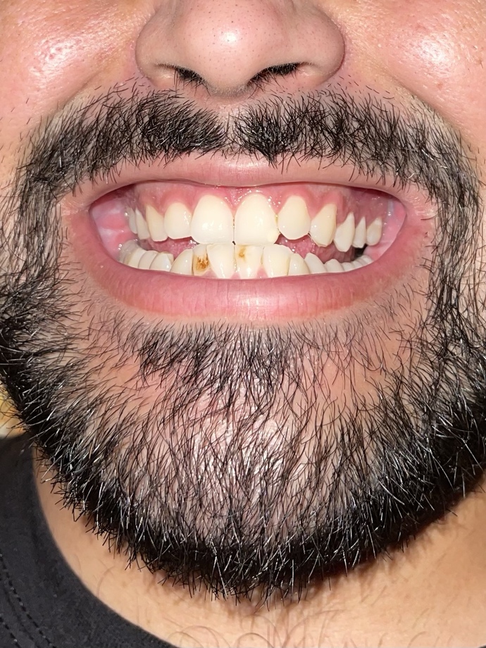 How long braces can take for my teeth and at what average cost?