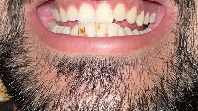 How long braces can take for my teeth and at what average cost?
