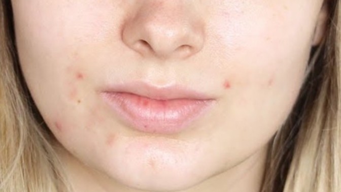 I can't look in the mirror, my skin is so pale and white, it looks sick and I have some acne spots, how can it look healthy?