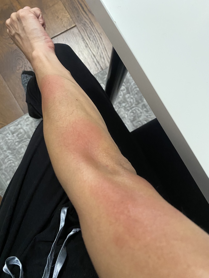 Help Why Do I Have Itchy Red Bumps On My Arm?