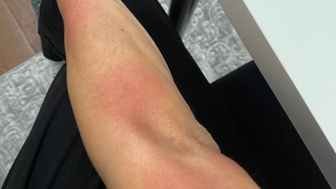 Help Why Do I Have Itchy Red Bumps On My Arm?