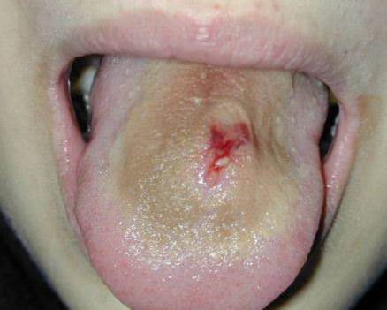 Infected tongue