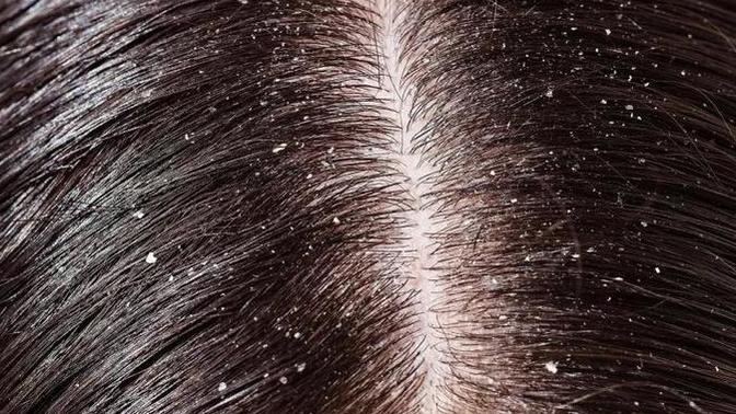 How to deal with dry scalp?