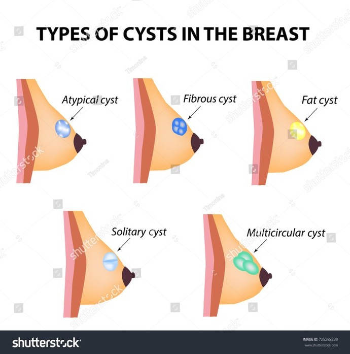 What can you do to get rid of a breast cyst?