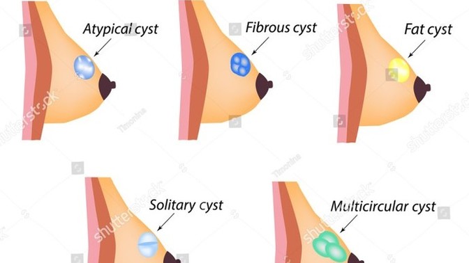 What can you do to get rid of a breast cyst?