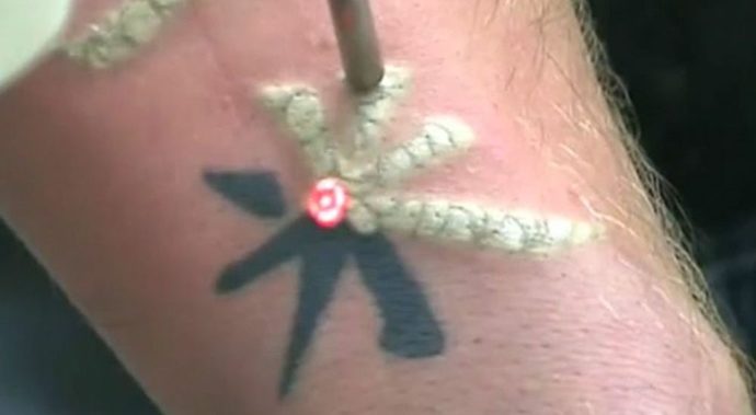 Why I am I so triggered and disgusted by tattoo removal videos with the frosting, but I still can’t look away?