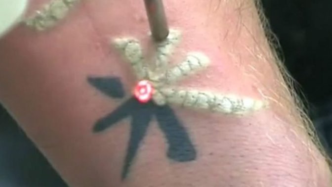 Why I am I so triggered and disgusted by tattoo removal videos with the frosting, but I still can’t look away?