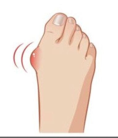 Do bunions turn you off and make you rather search for someone else?