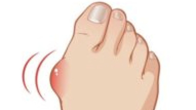 Do bunions turn you off and make you rather search for someone else?