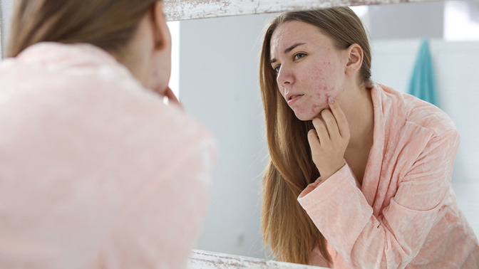 Does acne make a person seem younger?