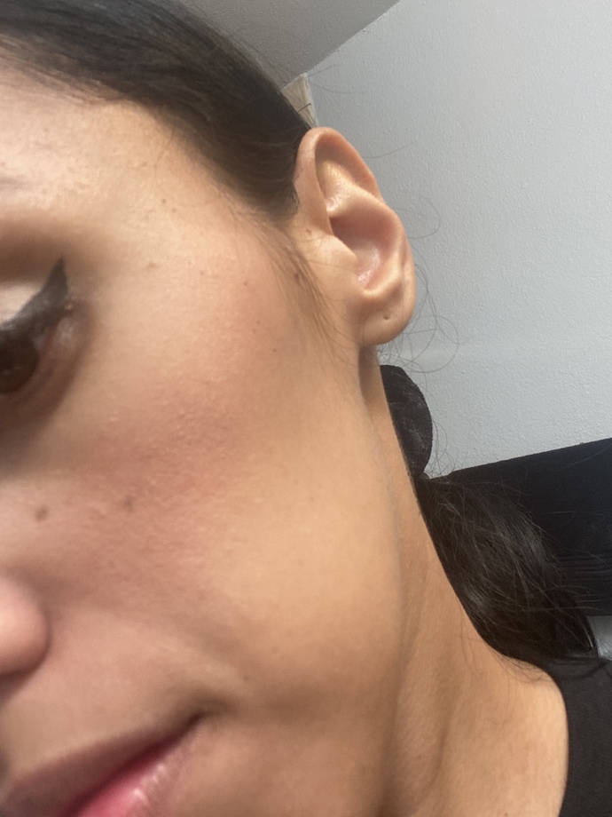 HELP WHY DOES MY MAKEUP & SKIN LOOK CAKEY AND DRY WITH ACNE?