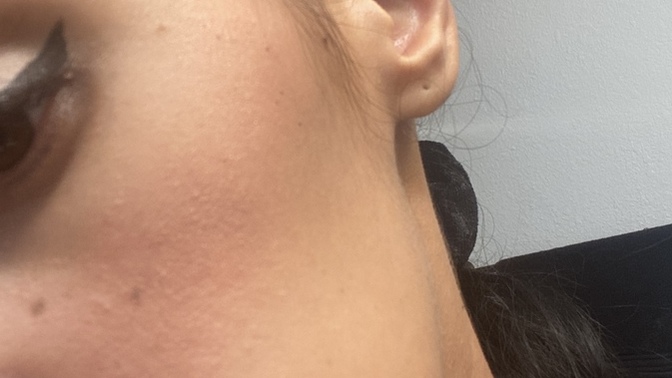HELP WHY DOES MY MAKEUP & SKIN LOOK CAKEY AND DRY WITH ACNE?