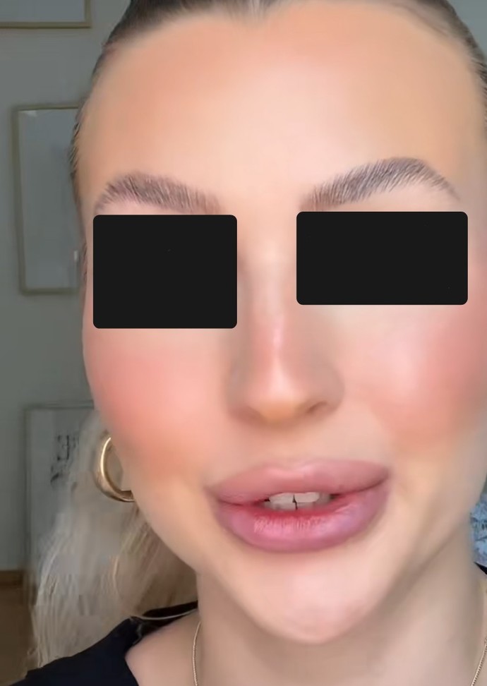 What do you think of injected lips like these?