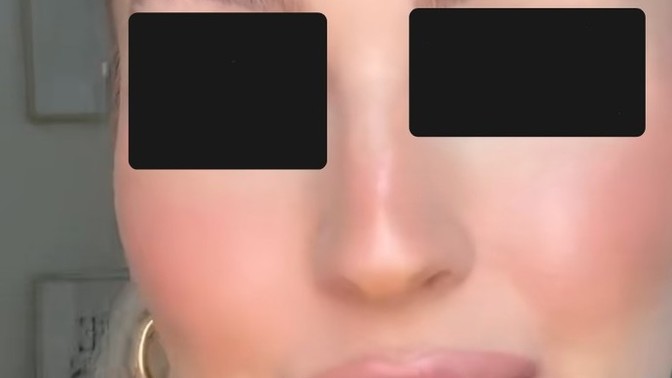 What do you think of injected lips like these?