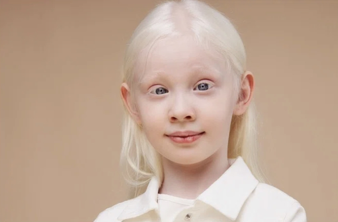 Why do blondes have albinism?