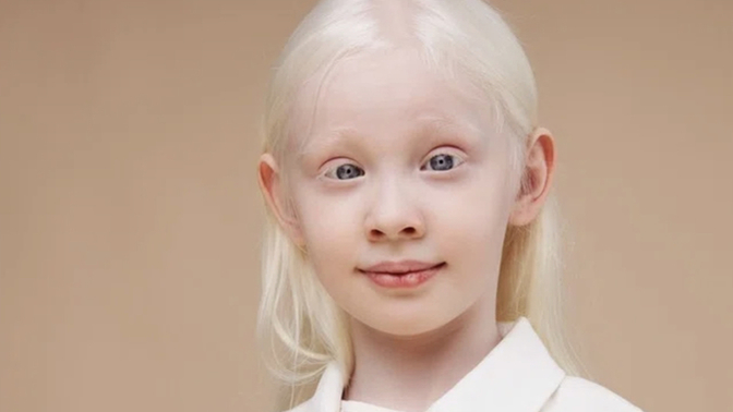 Why do blondes have albinism?