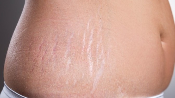 Do guys care about stretch marks?