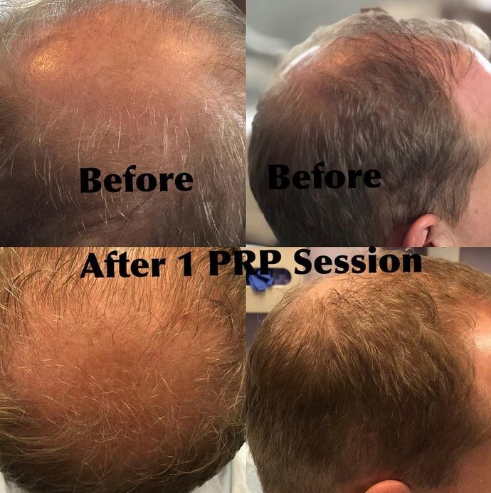 I am going bald at a very young age and I don't how to deal with it. What do I do?