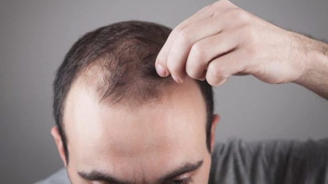 I am going bald at a very young age and I don't how to deal with it. What do I do?
